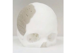 Реконструкция черепа в Израиле с помощью полимерного протеза