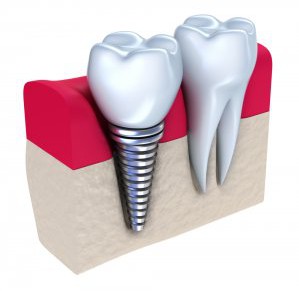 Что включает в себя стоимость услуга по имплантации зуба?