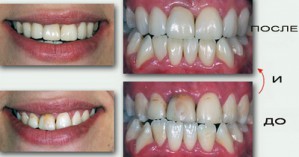 Несколько слов о прямой реставрации зубов