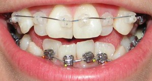 Выравнивание зубов брекетами damon clear: результат – очаровательная улыбка