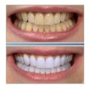 Методы отбеливания зубов